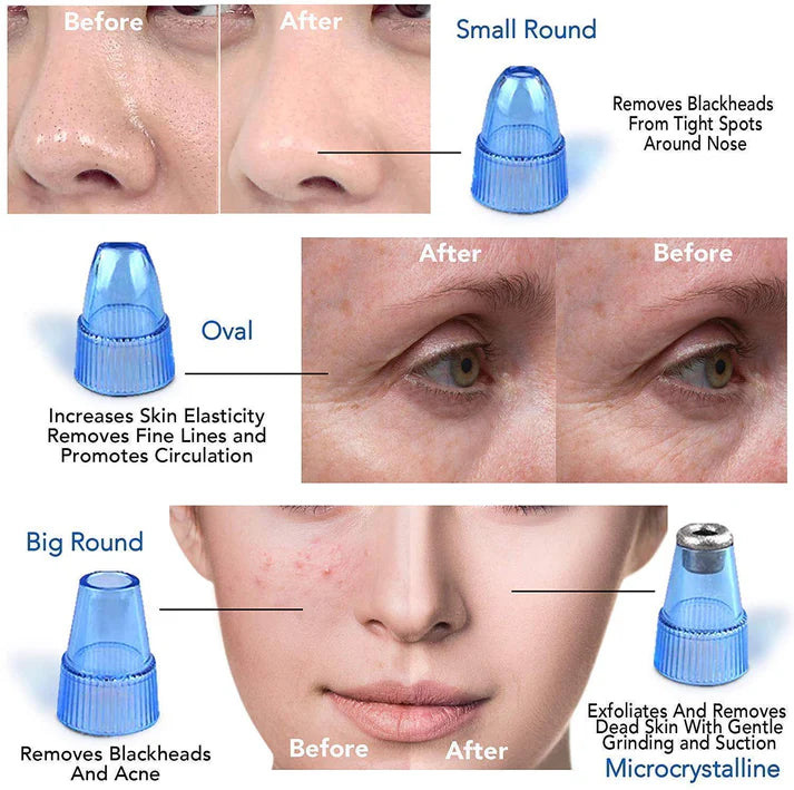 ✨ "Blackhead Removal Cosmetology Device – Deep Pore Cleaner, Safe & Effective Skincare Tool" 🌟💆‍♀️