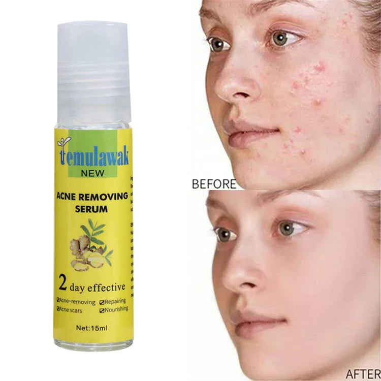 "Temulawak Original Acne Removing Serum – Clear Skin, Fade Blemishes & Boost Confidence"